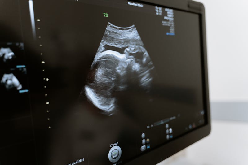 PCOS Ultrasound